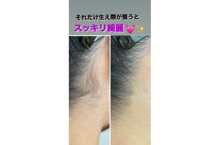 うなじ脱毛
